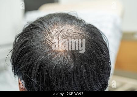 Glatze in der Mitte Kopf und beginnen keinen Verlust Haar glabrous der reifen asiatischen Geschäft smart aktiven Büromann. Stockfoto