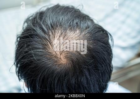 Glatze in der Mitte Kopf und beginnen keinen Verlust Haar glabrous der reifen asiatischen Geschäft smart aktiven Büromann. Stockfoto