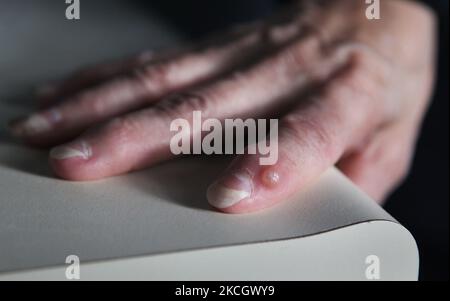 Eine digitale Schleimzyste am Finger einer Frau mittleren Alters in Markham, Ontario, Kanada. (Foto von Creative Touch Imaging Ltd./NurPhoto) Stockfoto