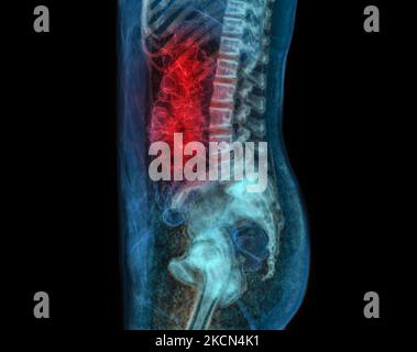 CT-Kolonographie oder CT-Scan von Colon 3D Rendering-Bild für das Screening von Kolorektalkrebs. Check Up Screening Colon Cancer. Stockfoto