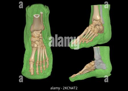 3D Darstellung der Fußknochen zur Diagnose Knochenbruch und rheumatoide Arthritis durch CT-Scanneranalyse. Stockfoto