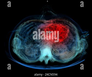 Menschliche Herzinfarkt Schmerz als eine Anatomie medizinische Krankheit Konzept, das eine Person leidet unter einer kardialen Erkrankungen als Schmerzhafte koronaren Ereignis mit 3D-Illus Stockfoto