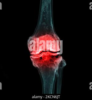 3D Rendering des Kniegelenks isoliert auf schwarzem Hintergrund zeigt Schmerzbereich. Stockfoto