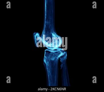 3D Rendering des Kniegelenks isoliert auf schwarzem Hintergrund zeigt Schmerzbereich. Stockfoto