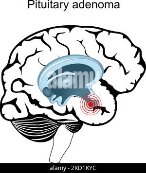 Hypophysenadenom. Querschnitt des menschlichen Gehirns. Nahaufnahme der Hypophyse. Endokrine Drüse. vektor-Poster Stock Vektor