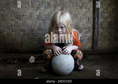 Jajang Gunawan (6), einer der Nachkommen Albinos, spielte am 9. Juni 2022 mit seinen Freunden im Dorf Ciburuy, Bezirk Garut, Provinz West-Java. (Foto von Aditya Irawan/NurPhoto) Stockfoto