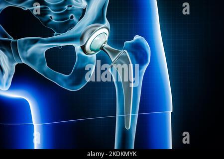 Hüftprothese oder Implantat des Oberschenkelkopfes. Total Hip Joint Replacement Chirurgie oder Arthroplastik 3D Rendering Illustration. Medizin und Gesundheitswesen, arthrit Stockfoto