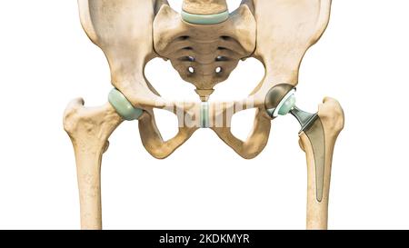 Hüftprothese oder Implantat isoliert auf weißem Hintergrund. Hüftgelenk- oder Femurkopfersatz 3D Rendering Illustration. Medizin, Medizin und Gesundheit Stockfoto