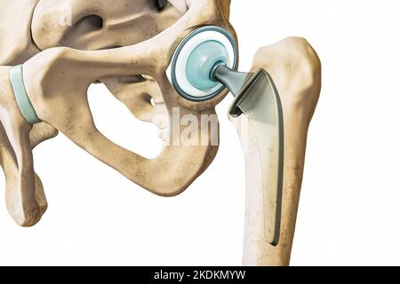 Hüftprothese oder Implantat isoliert auf weißem Hintergrund Nahaufnahme. Hüftgelenk- oder Femurkopfersatz 3D Rendering Illustration. Medizin, Medizin und Stockfoto