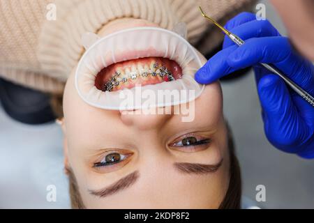 Die Zähne einer Frau mit Metallspangen werden in der Klinik behandelt. Ein Kieferorthopäde setzt Zahninstrumente ein, um Zahnspangen auf die Zähne eines Patienten zu legen. Auswahl Stockfoto