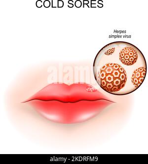 Lippenbläschen. Fieberblasen. Nahaufnahme eines Herpes-Simplex-Virus. Vektorgrafik Stock Vektor