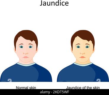 Gelbsucht. Anzeichen und Symptome von Krankheiten. Vergleich und Unterschiede zwischen gesundem Mann und Person mit gelblicher Pigmentierung der Haut und Sklera. Stock Vektor