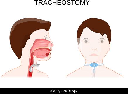 Tracheotomie. Seitenansicht des Halses und Platzierung eines Tracheostomieschlauchs in der Trachea. Außenansicht eines Patienten mit Tracheostomie in der Luftröhre. Stock Vektor