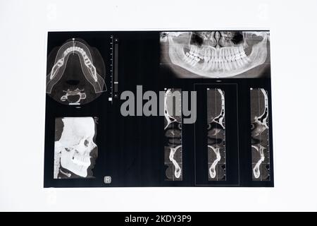CT-Scan eines Patienten mit Malokklusion, fehlendem Kauzahn und Funktionsstörungen des Kiefergelenks. Stockfoto