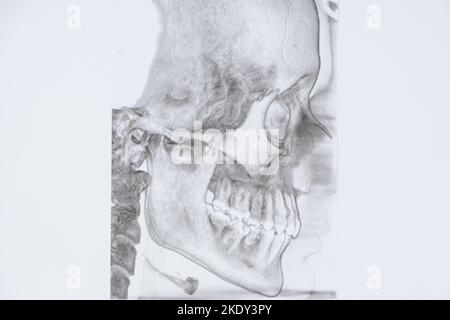 CT-Scan eines Patienten mit Malokklusion, fehlendem Kauzahn und Funktionsstörungen des Kiefergelenks. Stockfoto