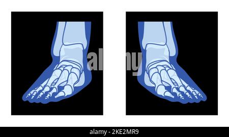 X-Ray Fuß Beine Skelett menschlicher Körper Knochen - Malleolus, Phalanges Erwachsene Menschen roentgen Vorderansicht. Realistisches flaches blaues Farbkonzept Vektordarstellung der medizinischen Anatomie auf schwarzem Hintergrund isoliert Stock Vektor