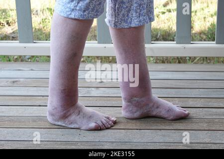 Untere Gliedmaßen der Frau mit Ödemen und Veneninsuffizienz Stockfoto