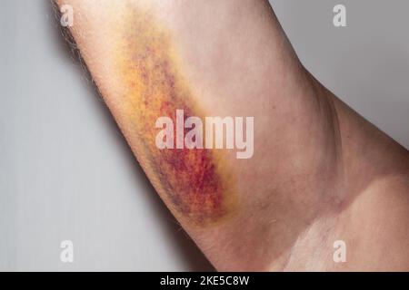 Der Arm eines Mannes mit einem großen farbigen Bluterguss auf der Haut auf der Innenseite seiner Schulter. Medizinisches Konzept. Stockfoto