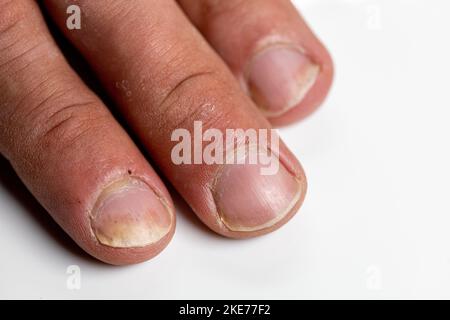 Eine Nahaufnahme der Finger eines Patienten mit psoriatischer Onychodystrophie oder psoriatischer Nagelerkrankung Stockfoto