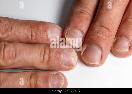 Eine Nahaufnahme der Finger eines Patienten mit psoriatischer Onychodystrophie oder psoriatischer Nagelerkrankung Stockfoto