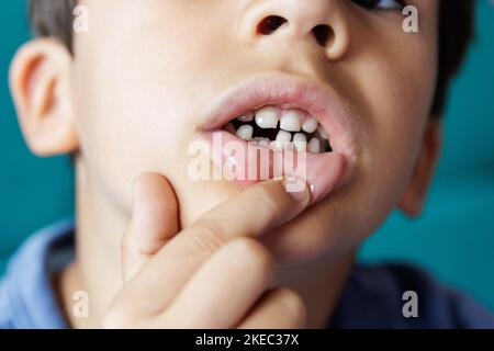 Kindermund mit Delle aufgrund von abgefallener Milchzähne Stockfoto