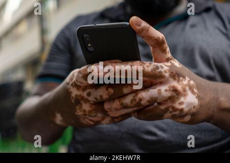 Ein Schwarzer mit Vitiligo benutzt ein Smartphone Stockfoto