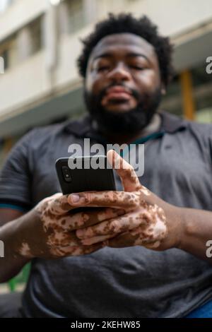 Ein Schwarzer mit Vitiligo benutzt ein Smartphone Stockfoto