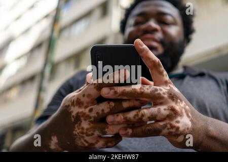 Ein Schwarzer mit Vitiligo benutzt ein Smartphone Stockfoto