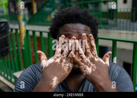 Ein Schwarzer mit Vitiligo benutzt ein Smartphone Stockfoto