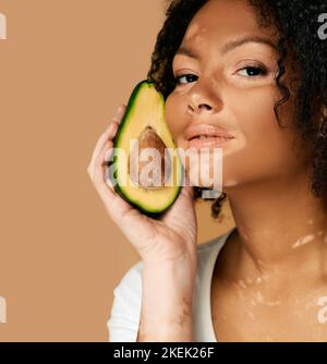 Kosmetik mit Avocado für pigmentierte Haut. Afrikanische Frau mit Vitiligo-Krankheit hält Avocado in der Nähe ihres Gesichts mit weißen Flecken Stockfoto