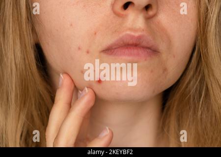 Nicht erkennbare Frau, die ihre Akne im Gesicht zeigt. Nahaufnahme Akne auf dem Gesicht der Frau mit Hautausschlag, Narbe und vor Ort, die allergisch auf Kosmetika. Problem Hautpflege und Gesundheitskonzept. Falten, Melasma, dunkle Flecken, Sommersprossen, trockene Haut, Akne Mitesser auf Gesicht mittleren Alters Frauen Kinn Akne Problem. Pickel auf dem Bart. Problem Haut in einem jungen Mädchen. Hormonelle Fehlbalance. Hauterkrankungen führen bei Frauen zu Depressionen und Unsicherheiten Stockfoto