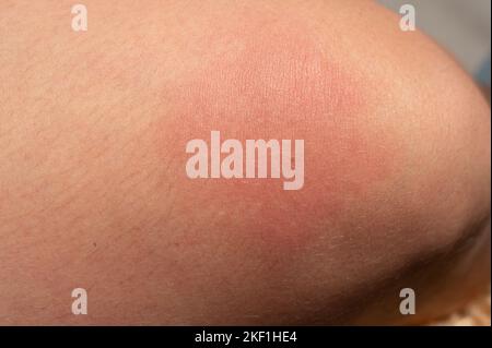 Allergie auf den menschlichen Körper und Rötung durch Wespenstich, Rötung und Stich aus der Nähe. Stockfoto