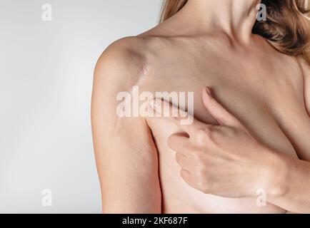 Frau haben Narbe auf der Schulter über weißem Hintergrund. Installation einer Metallplatte nach dem Bruch. Frau zeigt mit dem Finger auf die Schulternarbe. Stockfoto