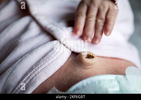 Neugeborene Hand und Nabel mit Nabelschnur sind gerade abgefallen, Nabelbruch bei Säuglingen. Stockfoto