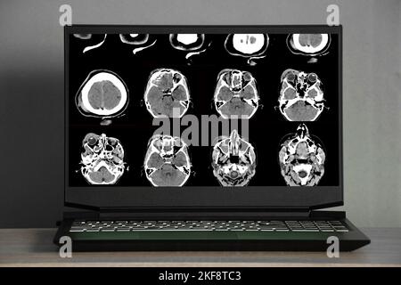 3D Computertomographie des Gehirns mit einem Bruch des frontalen Schädelteils nach einer Verletzung auf den Laptop-Bildschirmen auf dem Tisch, dem Schädel Stockfoto