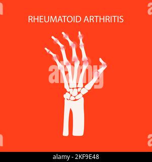 ARTHRITIS HAND Rheumatoide Krankheit chronische Krankheit Medizin Bildung Diagramm Vektor Schema menschliche Hand zeichnen Vektor Illustration Stock Vektor