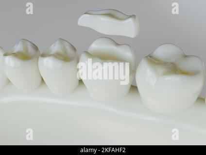 Keramik Inlay Krone über einem Zahn- 3D Rendering Stockfoto