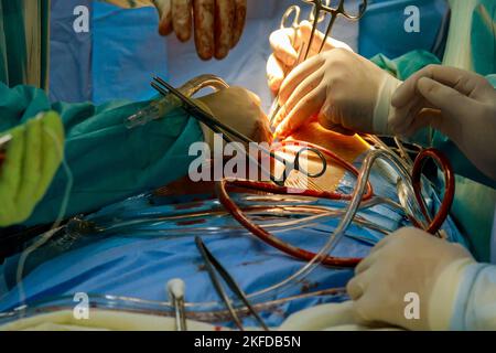 Koronarararterien-Bypass-Transplantat CABG für Herzoperationen aufgrund einer koronaren Herzerkrankung im Operationsraum des Krankenhauses Stockfoto