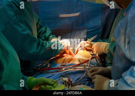 Operation am offenen Herzen aufgrund einer Fehlfunktion der Herzklappe wird der Klappenersatz im Operationssaal des Krankenhauses durchgeführt Stockfoto