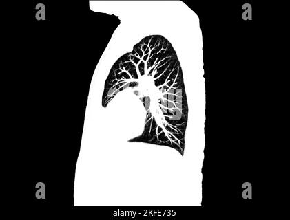 CT-Scan der sagittalen Thorax- oder Lungenansicht in der Radiologieabteilung im Krankenhaus. Covid-19 Scan-Röntgenuntersuchung des Körpers auf Covid-Virus-Epidemie-Ausbreitung con Stockfoto