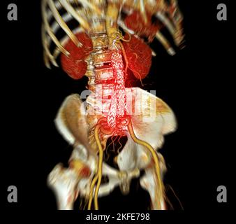 CTA-Ganzaorta mit abdominaler Aorta-Stenttransplantation Vergleich des 3D-Rendering-Bildes bei abdominalen Aortenaneurysmen. Stockfoto