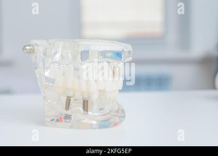 Ein Modell der Zähne mit Implantaten liegt auf einem Tisch im Büro Stockfoto