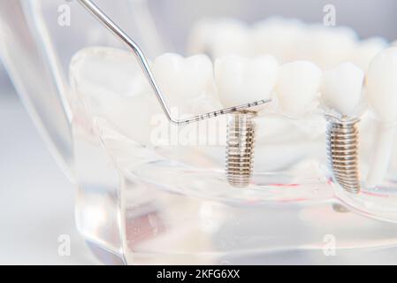 Ein Modell der Zähne mit Implantaten liegt auf einem Tisch im Büro Stockfoto