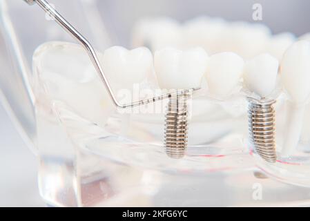 Ein Modell der Zähne mit Implantaten liegt auf einem Tisch im Büro Stockfoto