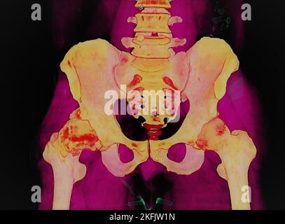 Arthrose der Hüfte, 3D CT-Scan Stockfoto