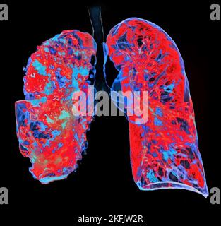 Pneumonie, 3D-CT-Scan Stockfoto