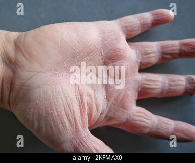 Trockene Haut an den Händen Stockfoto