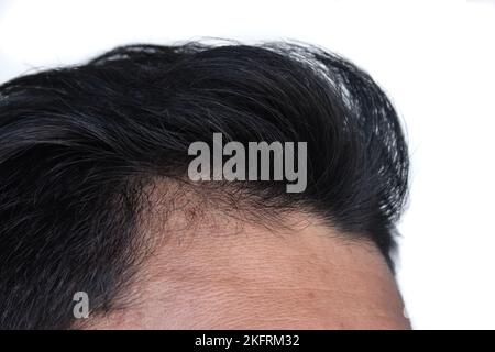 Dünner werdendes oder spärliches Haar, Haarausfall nach männlichem Muster in südostasiatischem, chinesischem jungen Mann. Stockfoto