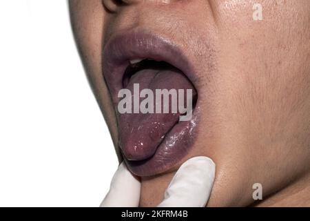 Zentrale Zyanose bei einem jungen Mann aus Südostasien mit angeborenem Herzfehler. Stockfoto