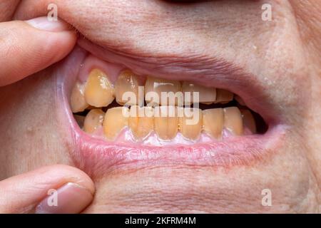 Überfüllte Zähne mit gelb gefärbten Tabakflecken. Schlechte Mundhygiene. Stockfoto